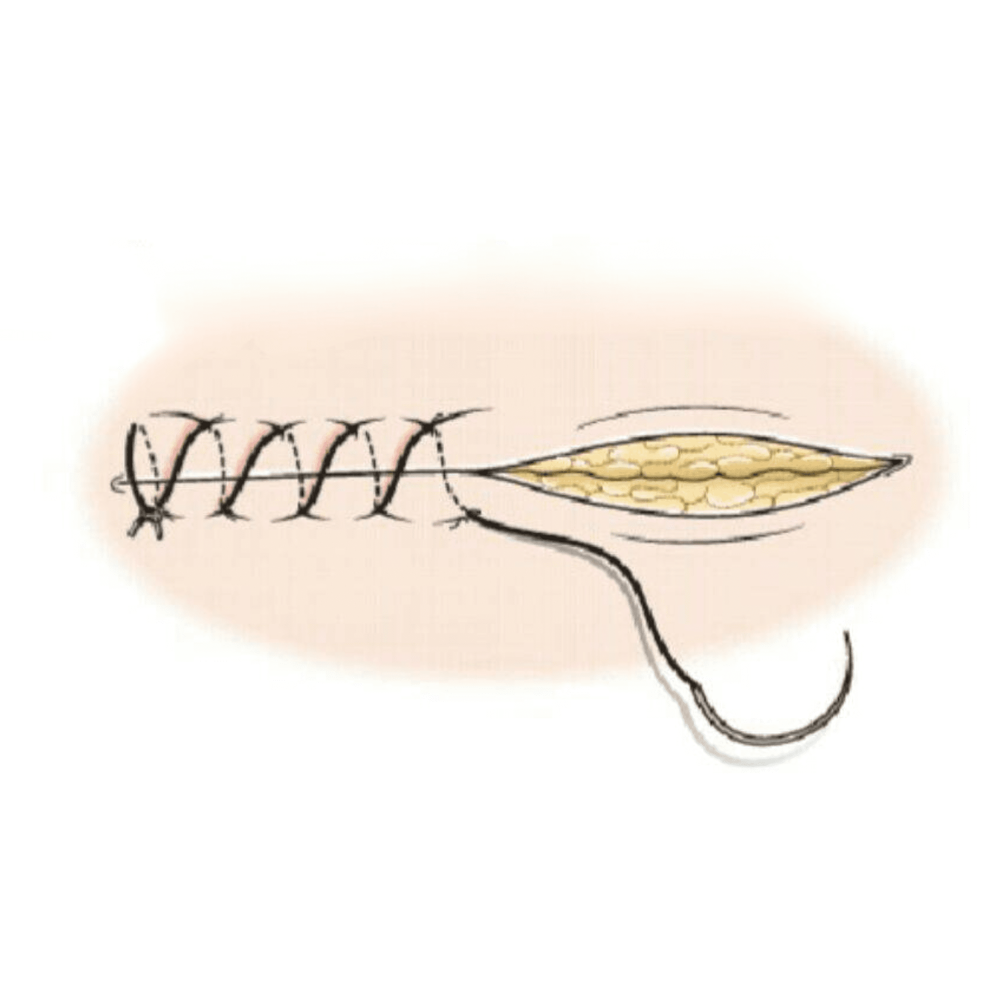 continuous suture