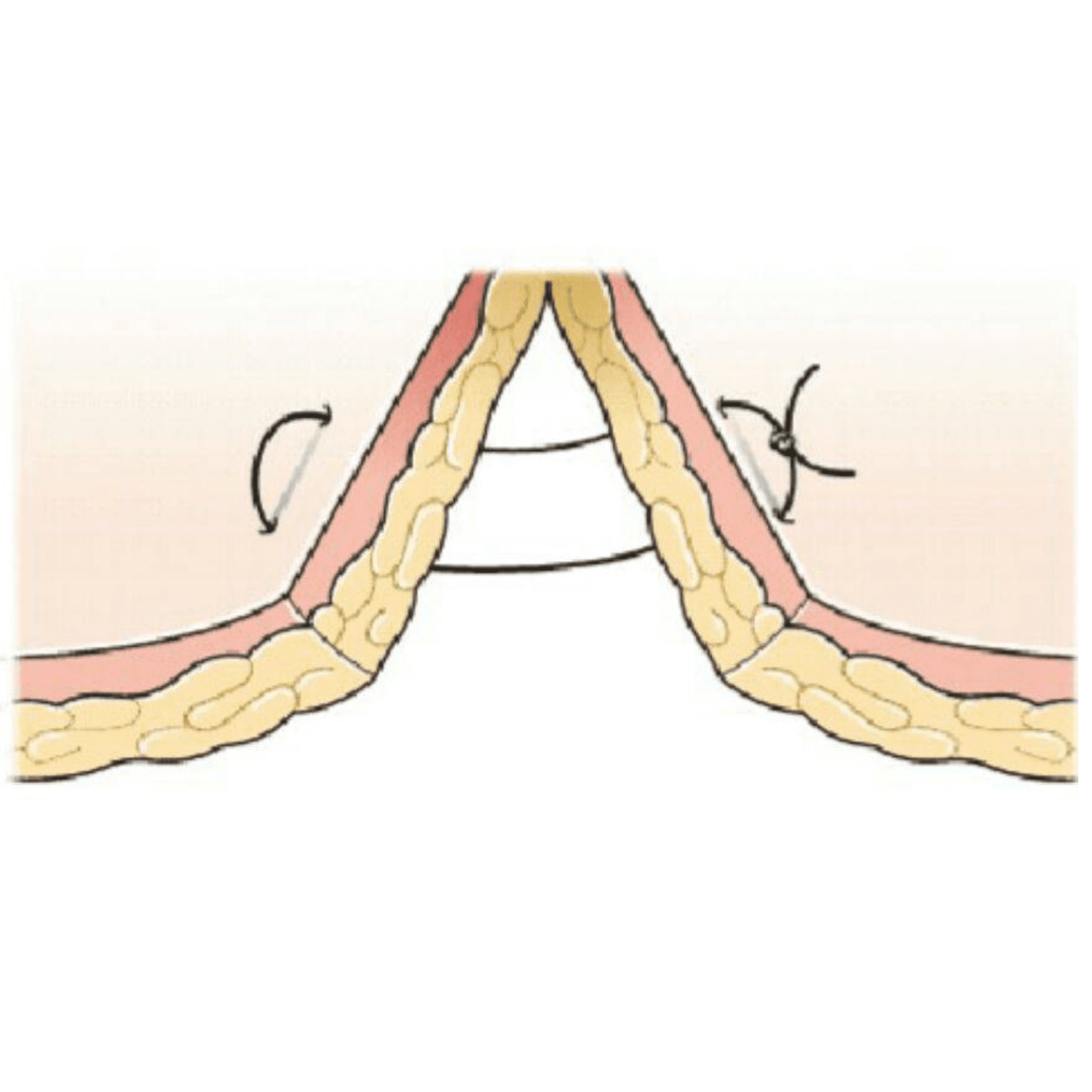 horizontal mattress suture