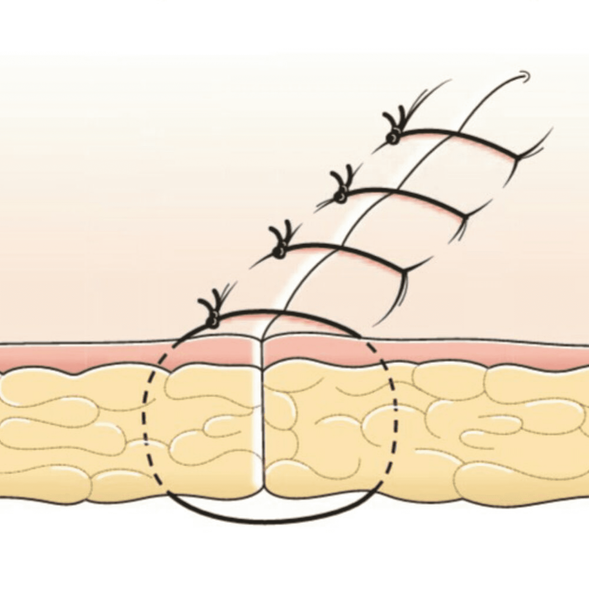 interrupted suture