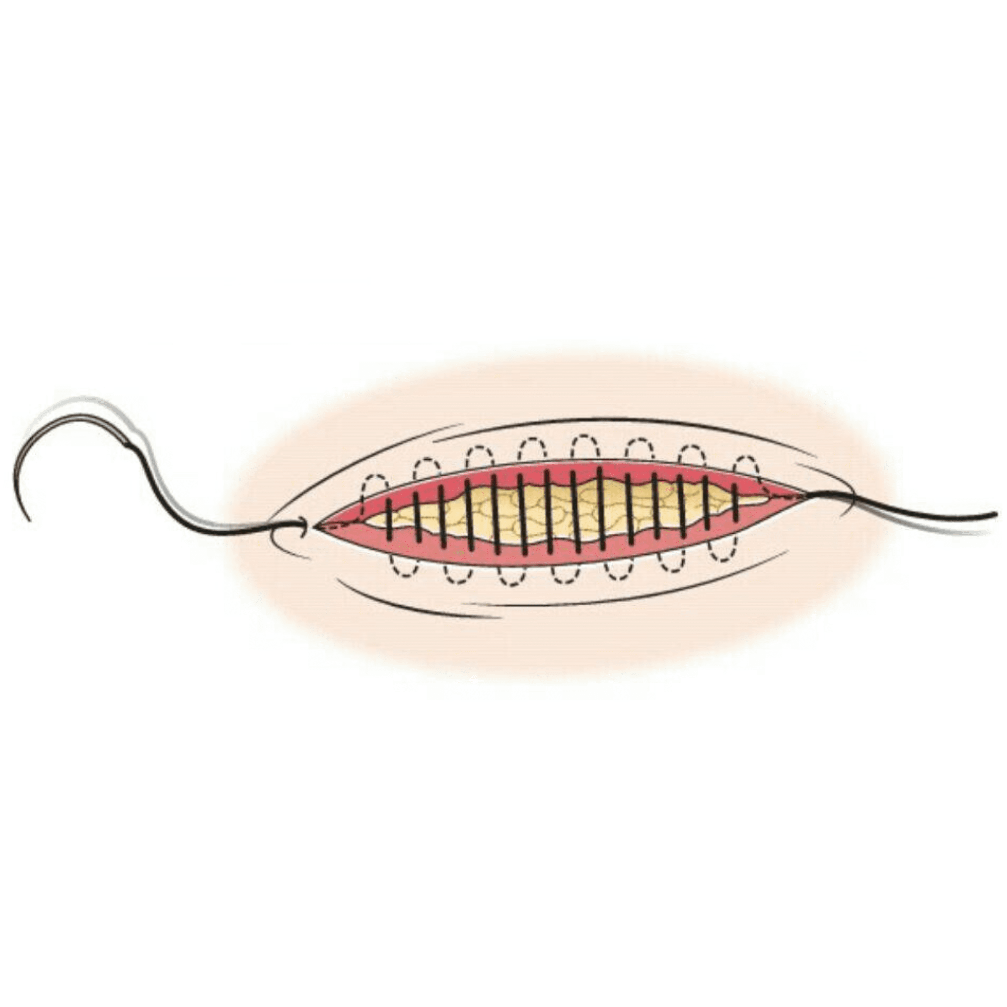 subcuticular suture
