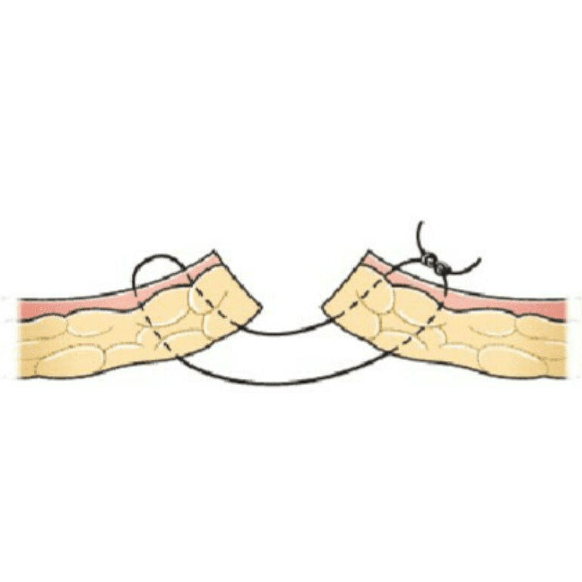 vertical mattress suture